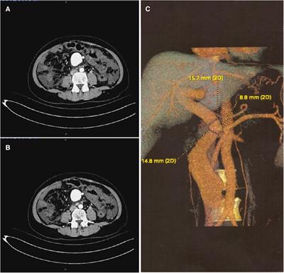 Endovascular comprehensive treatment of post-traumatic superior mesenteric arteriovenous fistula: case report and literature review